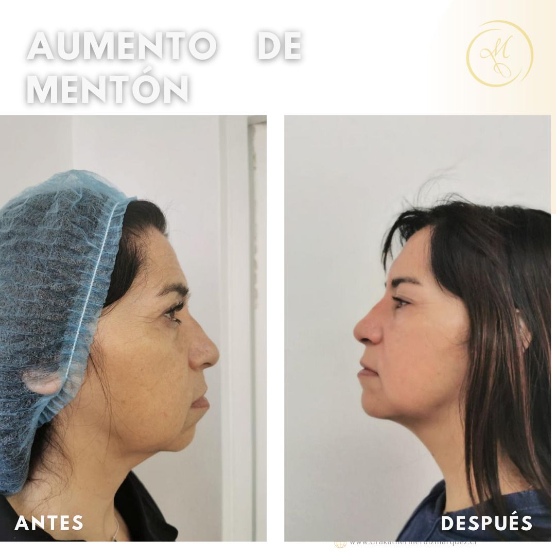 Mentoplastia Antes y después Clinicasesteticas cl Clinicasesteticas cl