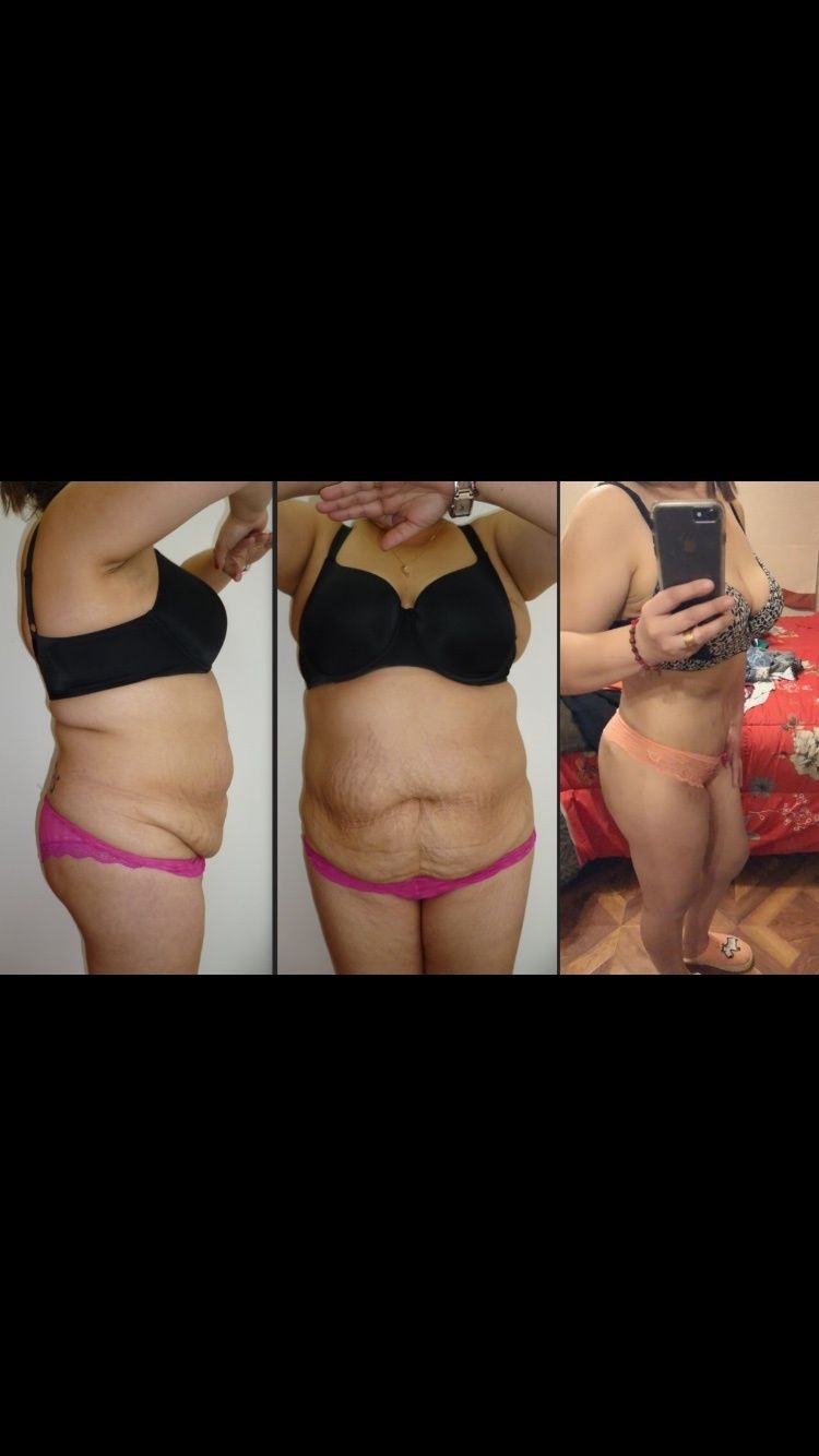 La abdominoplastia produjo muchos cambios en mi vida personal Puedo lucir más linda Un sueño