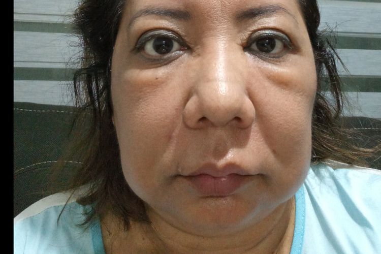 Inflamación en cara por ácido hialurónico Clinicasesteticas cl