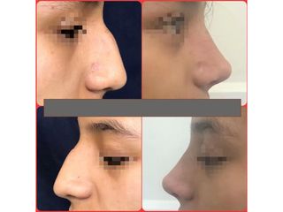 Rinoplastia - Dr. Ignacio Tapia Vargas