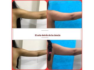 Liposucción de brazos - Dr. Ignacio Tapia Vargas