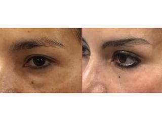 Blefaroplastia - Clínica Vaser Lipo Center