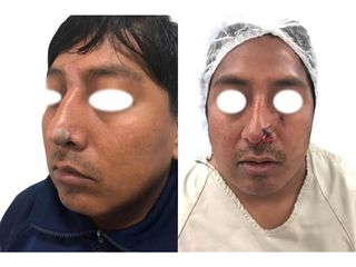 Rinoplastia - Clínica Vaser Lipo Center