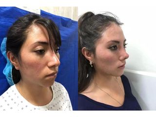 Rinoplastia - Clínica Vaser Lipo Center