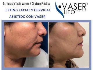 Lifting - Clínica Vaser Lipo Center