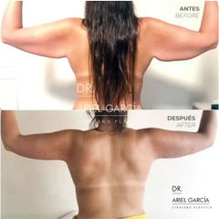 Braquioplastia - Dr. Ariel Ignacio García