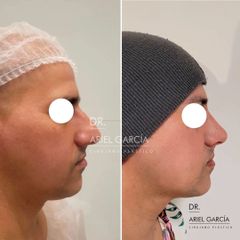 Rinoplastia - Dr. Ariel Ignacio García