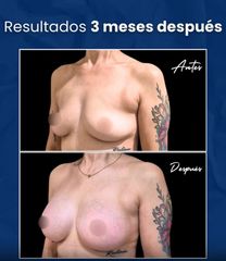 Aumento Mamario + Levantamiento - Dr. Damián Wengrowicz