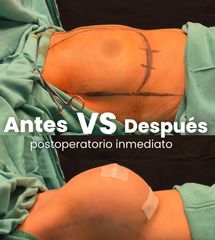 Aumento Mamario - Dr. Damián Wengrowicz