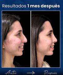 Rinoplastia - Dr. Damián Wengrowicz