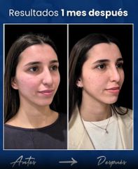 Rinoplastia - Dr. Damián Wengrowicz