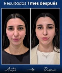 Rinoplastia - Dr. Damián Wengrowicz