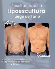 Lipoescultura