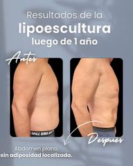 Lipoescultura - Dr. Damián Wengrowicz