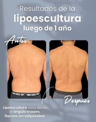 Lipoescultura - Dr. Damián Wengrowicz