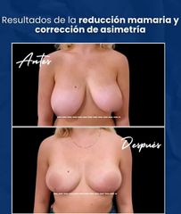 Reducción Mamaria - Dr. Damián Wengrowicz