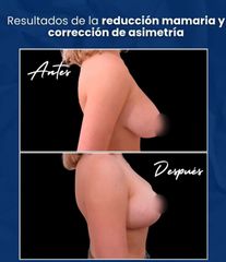 Reducción de Mamas - Dr. Damián Wengrowicz