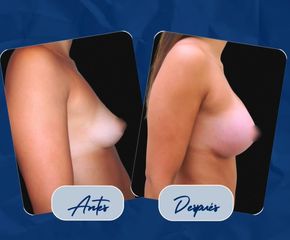 Aumento Mamario - Dr. Damián Wengrowicz