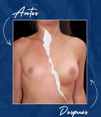 Aumento Mamario - Dr. Damián Wengrowicz