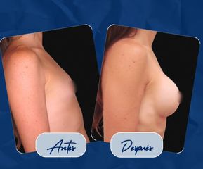 Aumento Mamario - Dr. Damián Wengrowicz