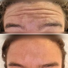 Botox - Dr Luis Corrales