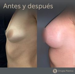 Aumento mamas - Desthetic