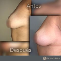 Aumento mamas - Desthetic
