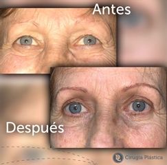 Blefaroplastia - Desthetic