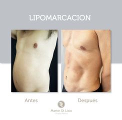 Lipomarcación - Desthetic