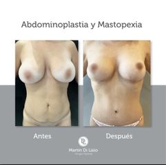 Abdominoplastia y Mastopexia - Desthetic