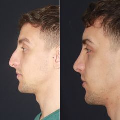 Rinoplastia - Dr. Williams Erik Bukret