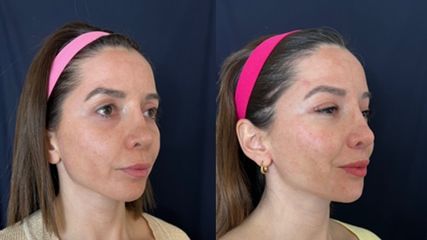Deep plane facelift before and after in Buenos Aires by Dr. Williams Erik Bukret