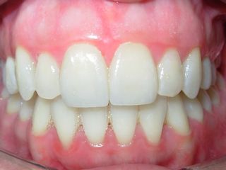 Carillas dentales final 