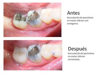 incrustacion dentales