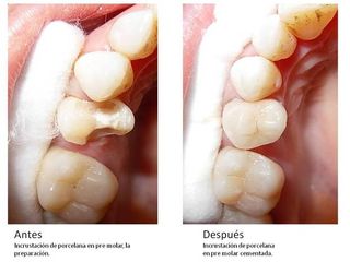 incrustacion dentales