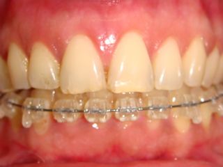 Ortodoncia lingual superior y esteica inferior dental advance