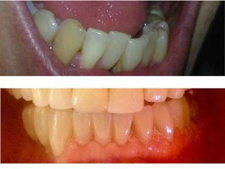 antes y despues carillas de porcelana - dental advance