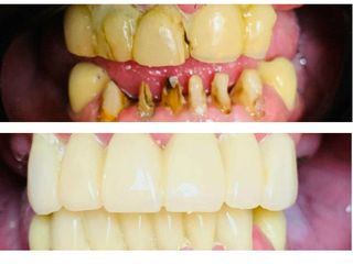 antes y despues coronas provisorias - dental advance