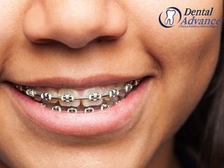 ortodoncia Dental Advance 