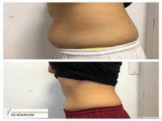 Lipoescultura sin cirugía