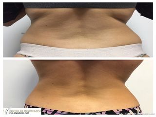 Lipoescultura sin cirugía