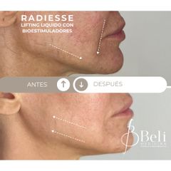 Lifting Radiesse - Beli Dr. Ingerflom