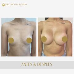 Aumento mamas - Dra. Micaela Taverna