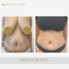 Abdominoplastia - Dra. Micaela Taverna