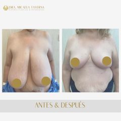 Reducción mamas - Dra. Micaela Taverna