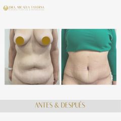 Abdominoplastia - Dra. Micaela Taverna