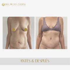 Abdominoplastia - Dra. Micaela Taverna