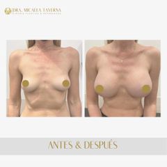 Aumento mamas - Dra. Micaela Taverna