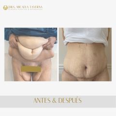 Abdominoplastia - Dra. Micaela Taverna