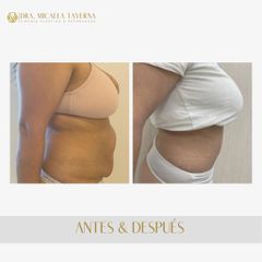 Abdominoplastia - Dra. Micaela Taverna